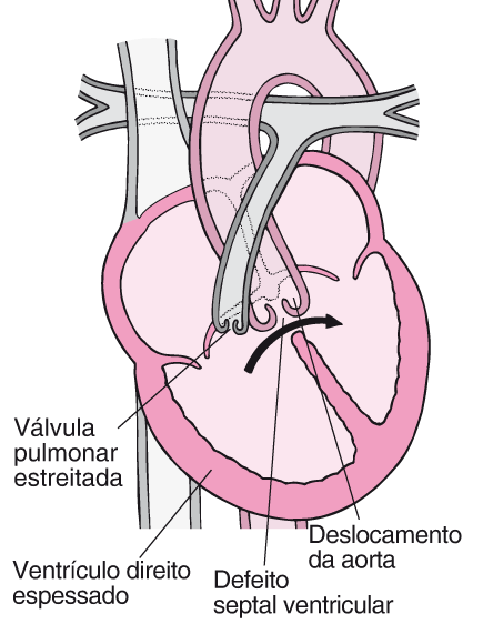 TETRALOGIA FALLOT - HEMODINÂMICA